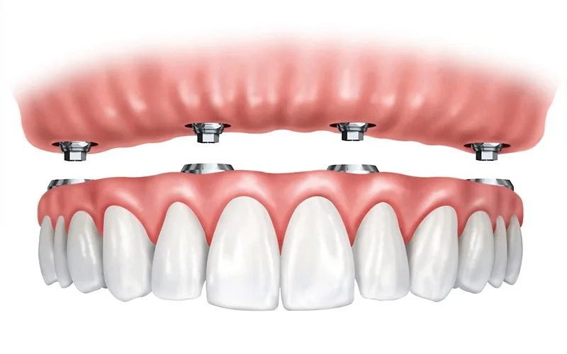 Prótesis sobre implantes