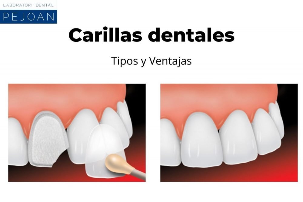 Carillas dentales