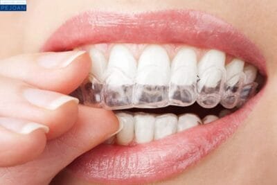 Ferula dental
