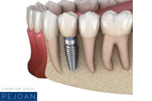 desventajas implante dental