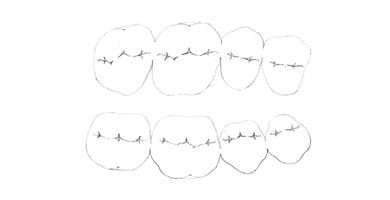 plano oclusal