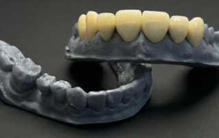 carillas disilicato de litio