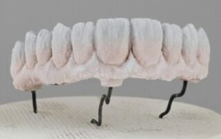 arcada completa metal ceramica