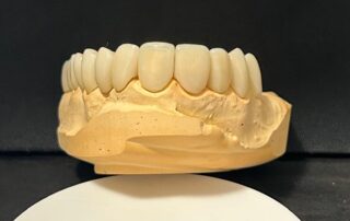 carillas disilicato de litio