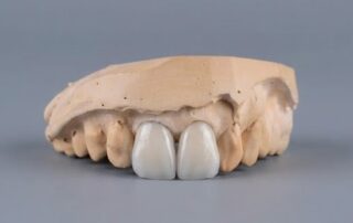 fundas circonio ceramica