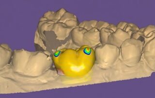 metal ceramica funda 3D